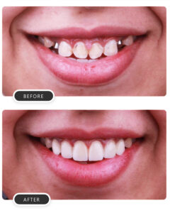 tooth coloured fillings