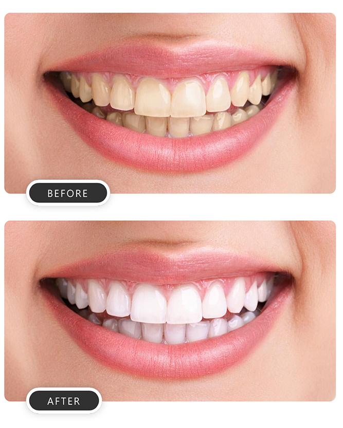 tooth whitening services