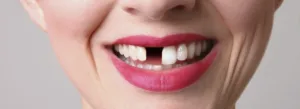 Missing tooth smile dental colombo the best dental surgery clinic in colombo