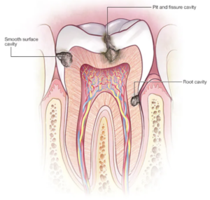 dental caries cavity