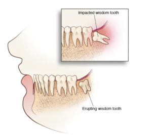 wisdom tooth wisdom teeth