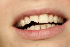 Broken tooth cracked tooth teeth